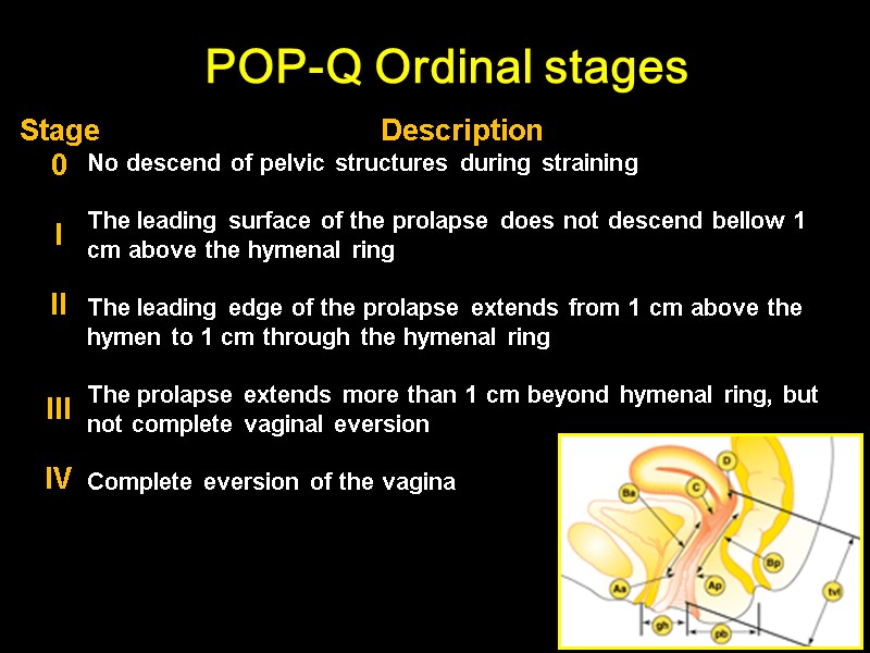 POP-Q Ordinal stages     Stage 0  I  II 